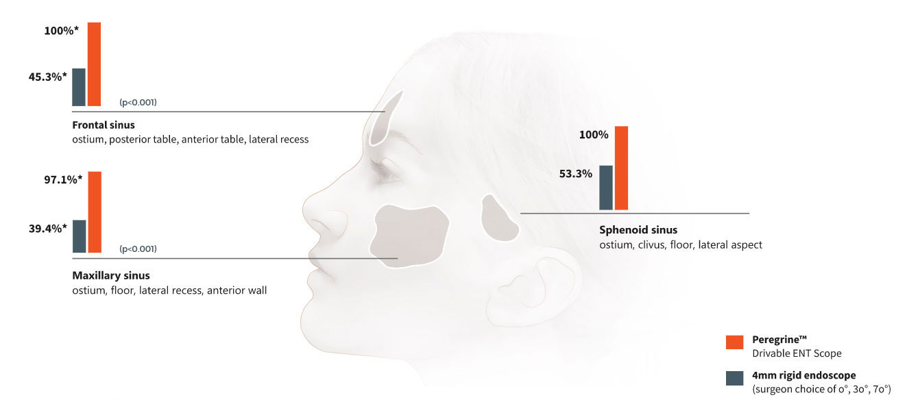 Superior-Intra-Sinus-Visualization-Peregrine-3