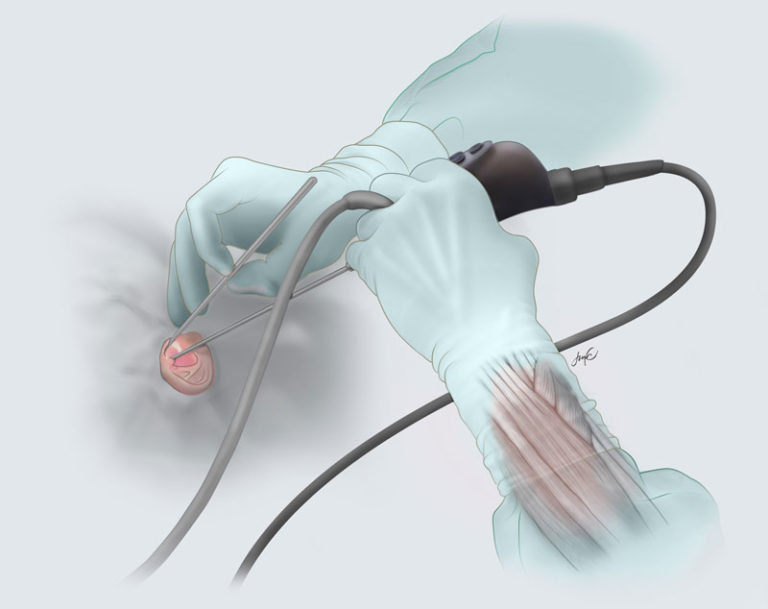 Colibri™ provides stable and secure endoscopic ear surgery